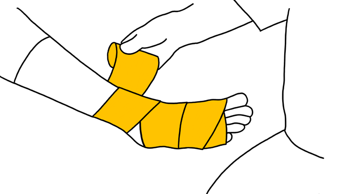 Diagram 17: Start wrapping below sprain towards the heart.